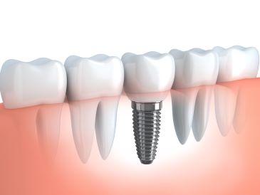 dental implants rutland